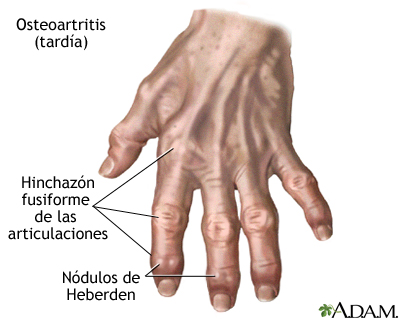 El Cannabis medicinal y la Artritis y Artrosis