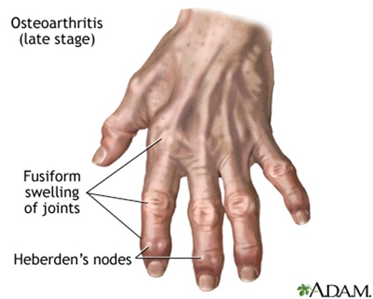 hand-with-Arthritis