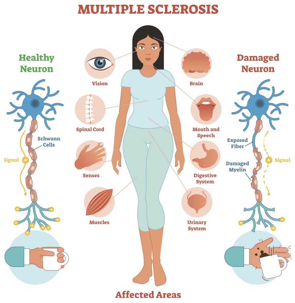 Aceite de CBD y Esclerosis Multiple