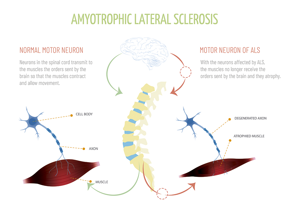 Esclerosis Lateral Amiotrófica y Aceite de CBD